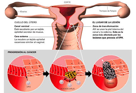 cancer utero